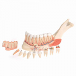 Advanced Half Lower Jaw Model, 8 Diseased Teeth_noscript