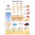 Chart "Decubitus Ulcers"_noscript