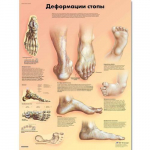 Chart "Deformities of the Feet" Russian_noscript