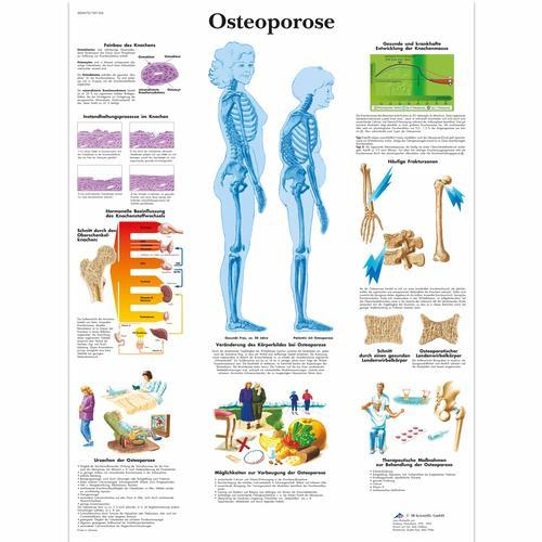 3b Scientific 1001306, Chart "osteoporose"