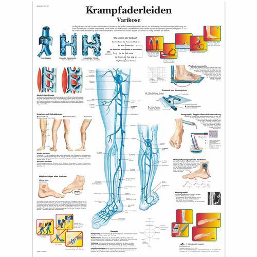 3b Scientific 1001371, Chart "krampfaderleiden Varikose"