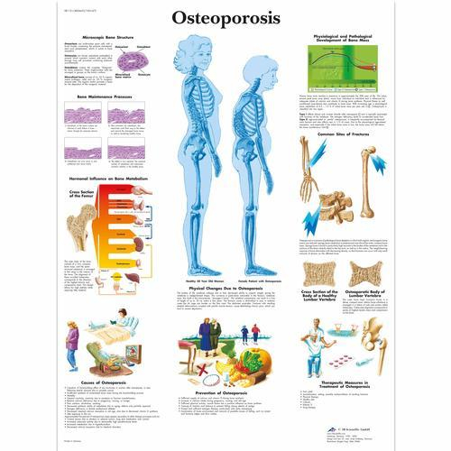 3b Scientific 1001472, Chart "osteoporosis"