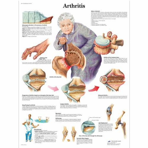 3b Scientific 1001474, Chart "arthritis"