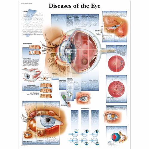 3b Scientific 1001498, Chart "diseases Of The Eye"