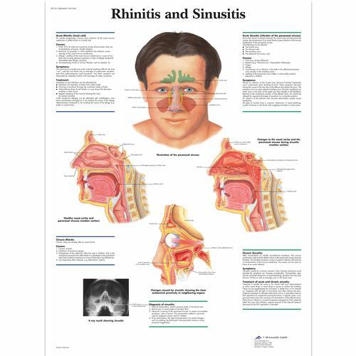 3b Scientific 1001504, Chart "rhinitis And Sinusitis"