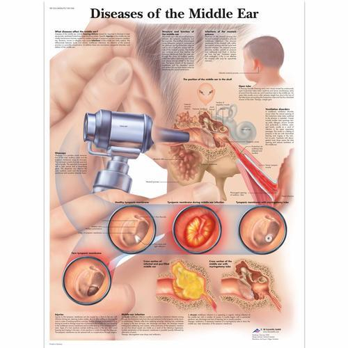 3b Scientific 1001506, Chart "diseases Of The Middle Ear"