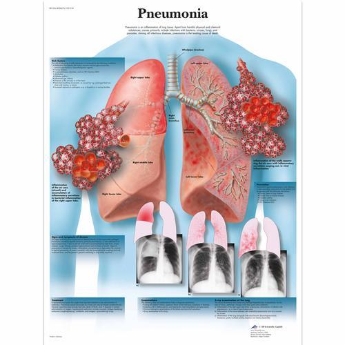 3b Scientific 1001518, Chart "pneumonia"