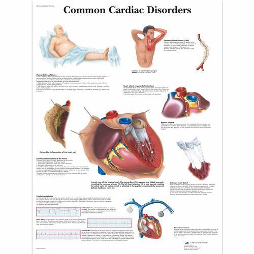 3b Scientific 1001526, Chart "common Cardiac Disorders"