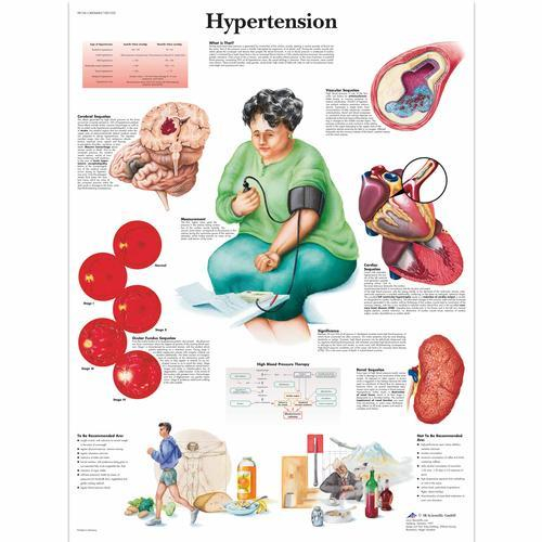 3b Scientific 1001532, Chart "hypertension"