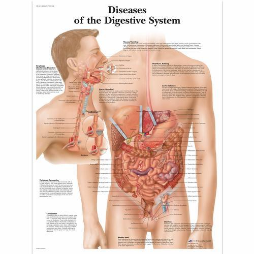 3b Scientific 1001548, Chart "diseases Digestive System"