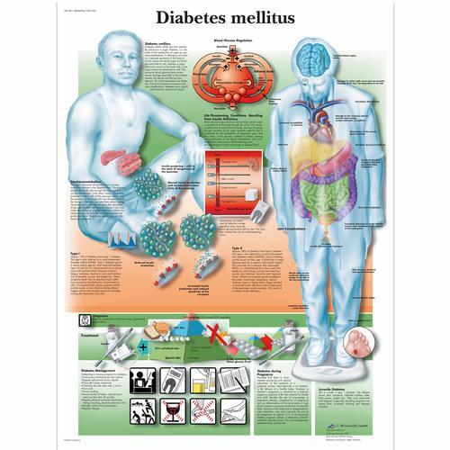 3b Scientific 1001554, Chart "diabetes Mellitus"