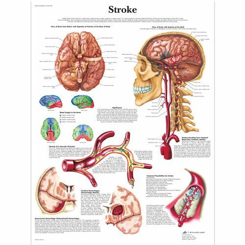 3b Scientific 1001590, Chart "stroke"
