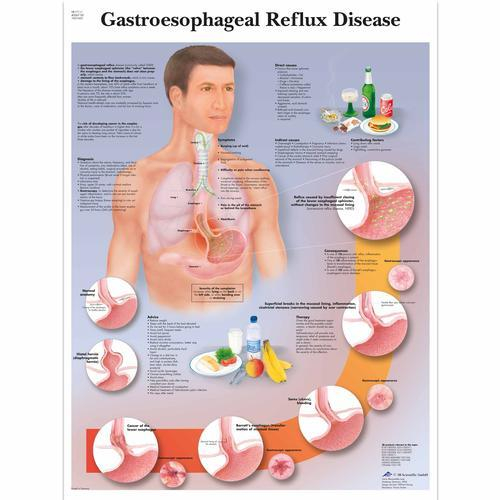 3b Scientific 1001602, Chart "gastroesophageal Reflux Disease"