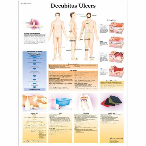 3b Scientific 1001606, Chart "decubitus Ulcers"