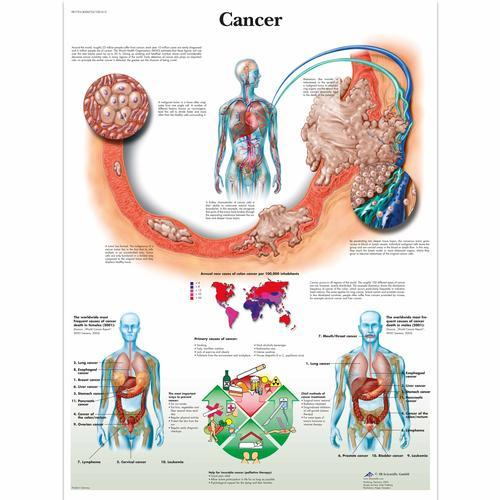 3b Scientific 1001612, Chart "cancer"