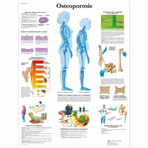 3b Scientific 1001803, Chart "osteoporosis"