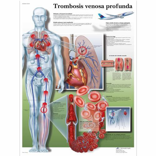 3b Scientific 1001867, Chart "trombosis Venosa Profunda"