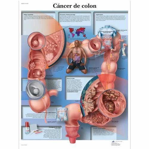 3b Scientific 1001881, Chart "cancer De Colon"