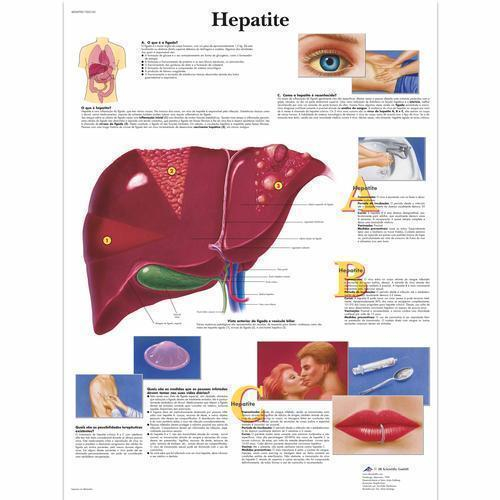 3b Scientific 1002165, Chart "hepatite" Portuguese