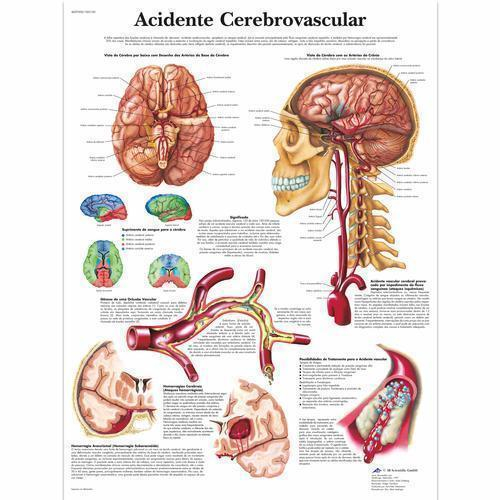 3b Scientific 1002185, Chart "acid Cerebrovascular" Portuguese