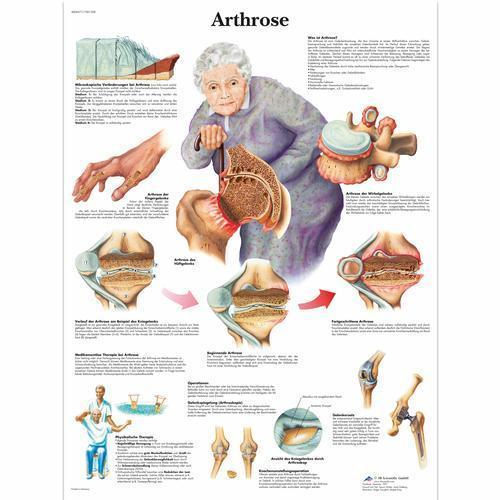 3b Scientific 4006571, Chart "arthrose", German, Paper