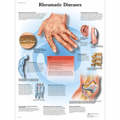 3b Scientific 4006655, Chart "rheumatic Diseases", Paper
