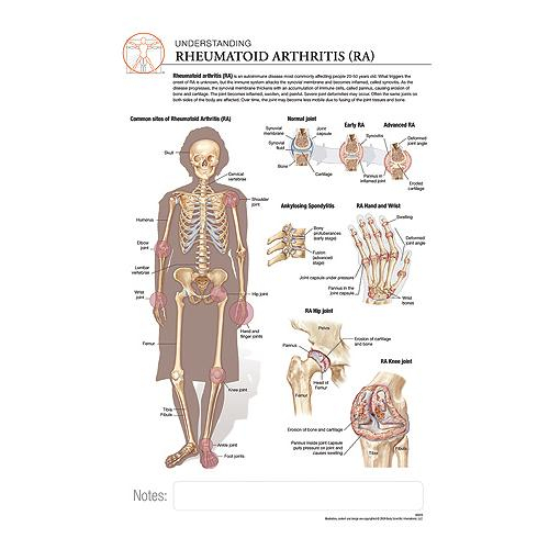 Fischer Technical Company Bs313, Rheumatoid Arthritis "post It" Chart